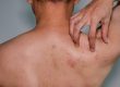 Shingles