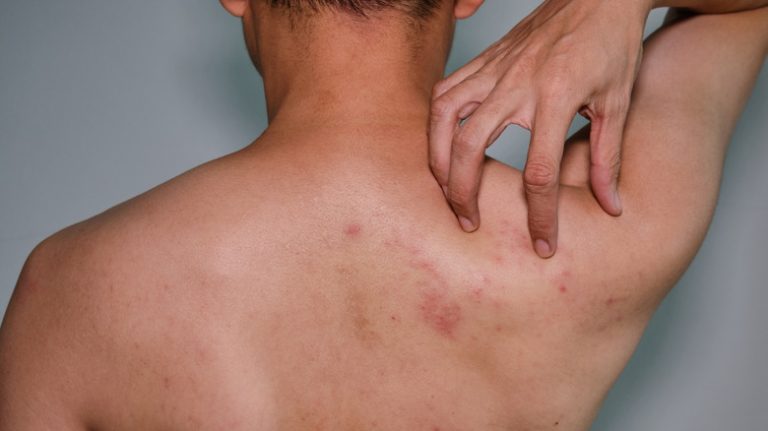 intro-1636749266 Shingles