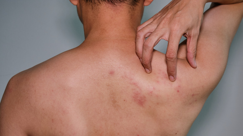 Shingles - On The Rise - Doctor In My Pocket